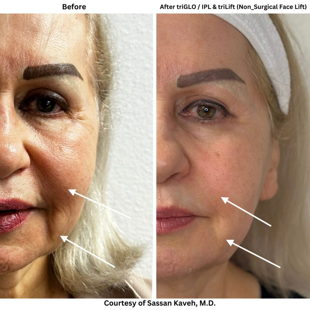 Alpha_Medical_Aesthetics_Lumenis_triLift_Non_Surgical_Facelifts_Benefits_Medical_Spa_Dr._Sassan_Kaveh_Las_Vegas