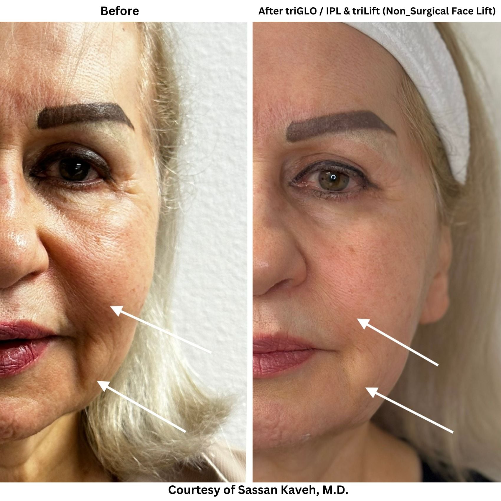 Natural-looking non-surgical facelift results in Las Vegas