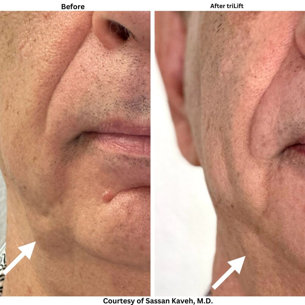 Alpha_Medical_Aesthetics_Lumenis_triLift_Non_Surgical_Facelifts_Benefits_Medical_Spa_Dr._Sassan_Kaveh_Strip_Las_Vegas Alpha_Medical_Aesthetics_Lumenis_triLift_Non_Surgical_Facelifts_Benefits_Medical_Spa_Dr._Sassan_Kaveh_Strip_Las_Vegas