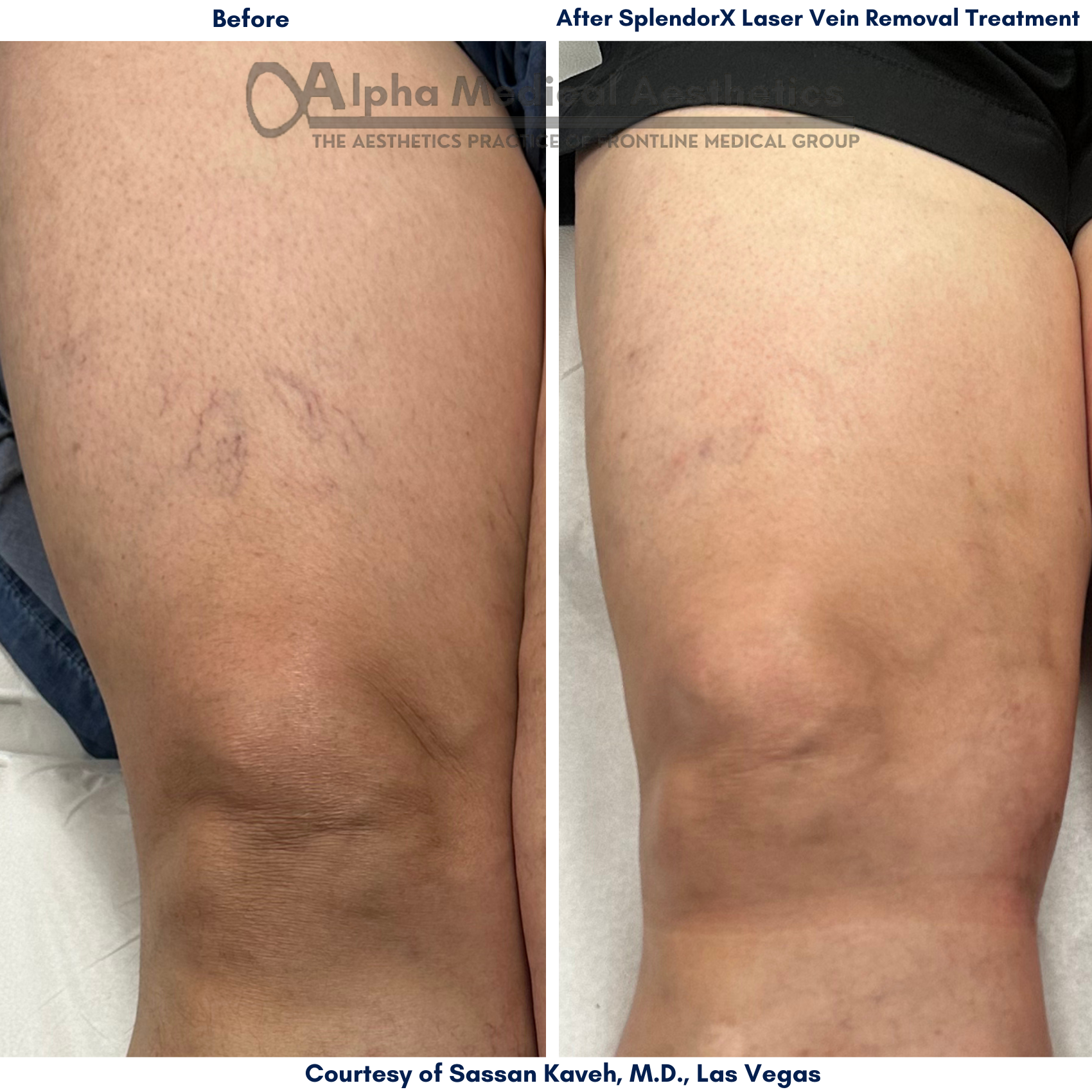 Alpha Medical Aesthetics Laser Spider Vein Removal