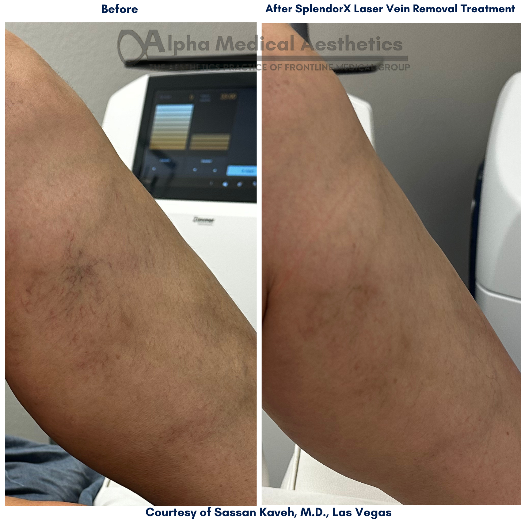 Alpha Medical Aesthetics Performs NdYAG Vein Removal by. Dr Sassan Kaveh in Las Vegas