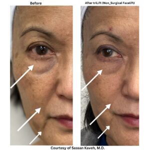 Alpha_Medical_Aesthetics_Lumenis_SmoothGLO_Marionette_Reduction_Angel_Park