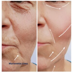 Alpha_Medical_Aesthetics_Lumenis_triLift_Non_Surgical_Facelift_Marionette_Reduction_The_Lakes