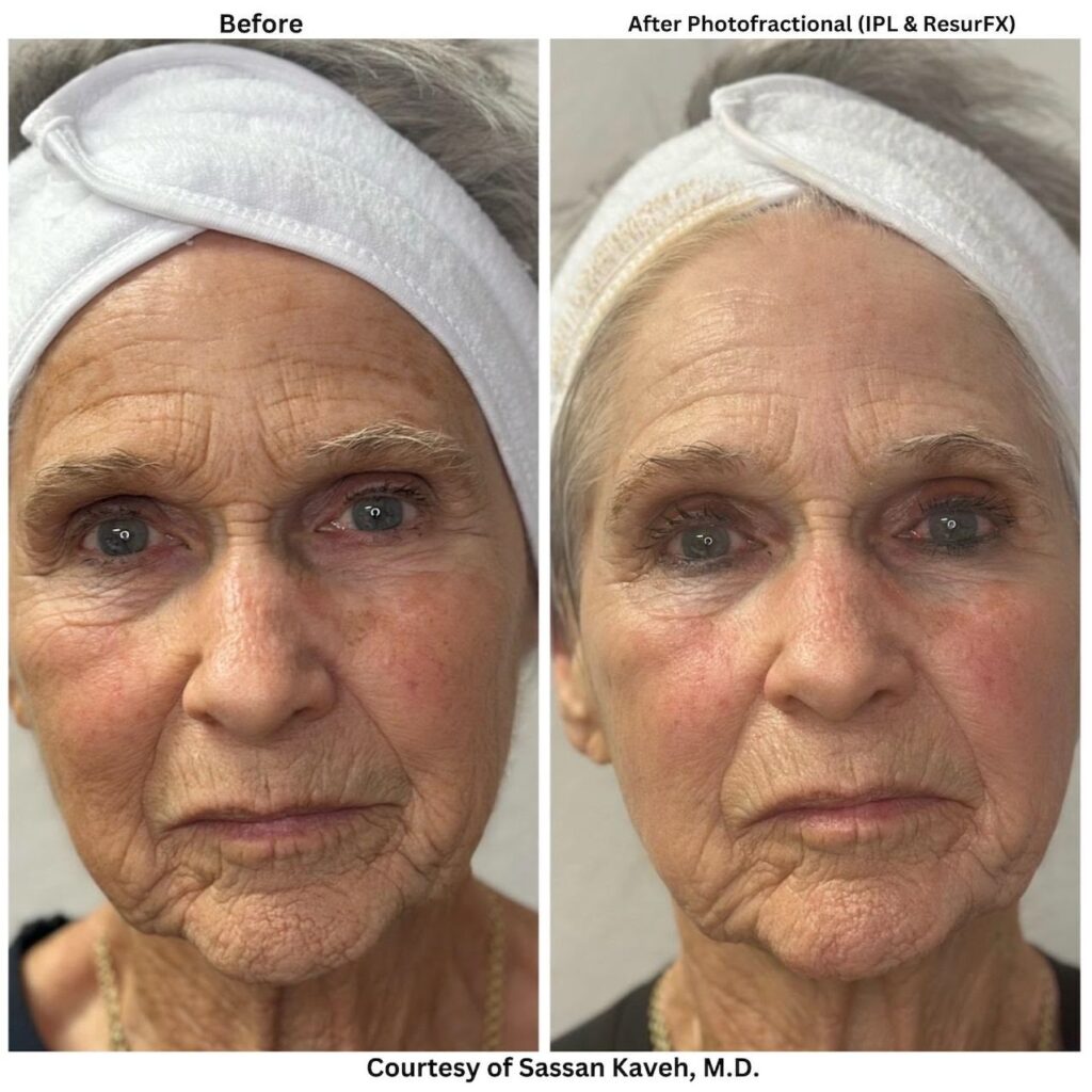 Alpha_Medical_Aesthetics_Lumenis_Non_Ablative_Laser_Resurfacing_ResurFX_Skin_Tightening_Dr._Sassan_Kaveh_Las_Vegas Alpha_Medical_Aesthetics_Lumenis_Non_Ablative_Laser_Resurfacing_ResurFX_Skin_Tightening_Dr._Sassan_Kaveh_Las_Vegas