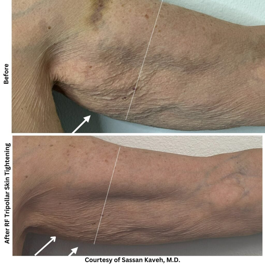 Alpha_Medical_Aesthetics_Lumenis_Radio_Frequency_Laser_Skin_Tightening_Dr._Sassan_Kaveh_Las_Vegas Alpha_Medical_Aesthetics_Lumenis_Radio_Frequency_Skin_Tightening_Dr._Sassan_Kaveh_Las_Vegas