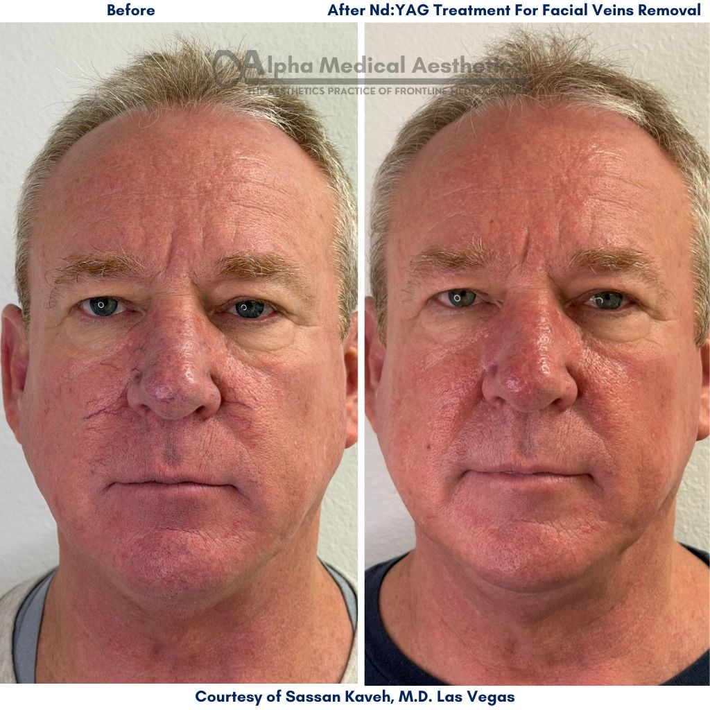 Alpha Medical Aesthetics Facial Vein Removal