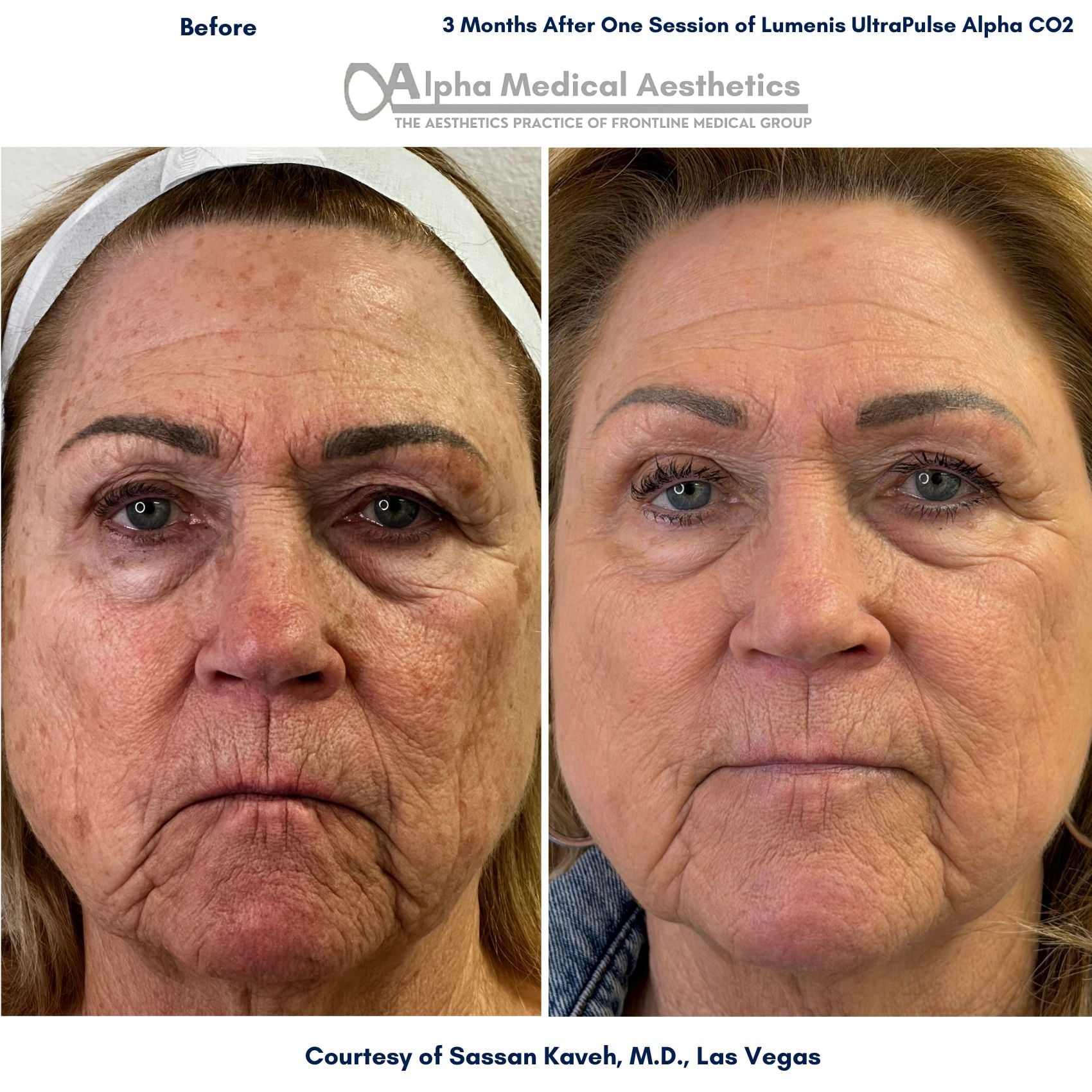 Alpha Medical Aesthetics Lumenis UltraPulse Alpha CO2 Laser Before and After Pictures by Dr Sassan Kaveh in Summerlin of Las Vegas