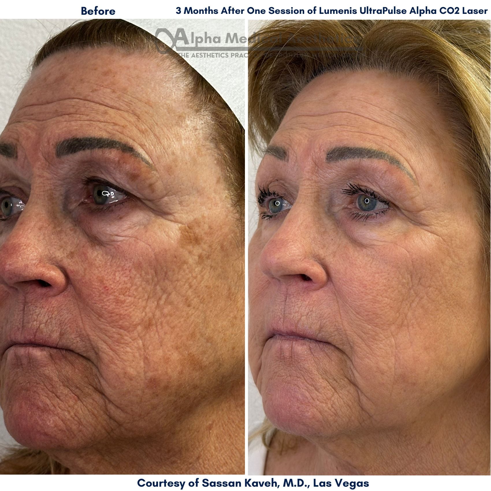 Alpha Medical Aesthetics Lumenis UltraPulse Alpha CO2 Laser Before and After Pictures by Dr Sassan Kaveh in Summerlin of Las Vegas