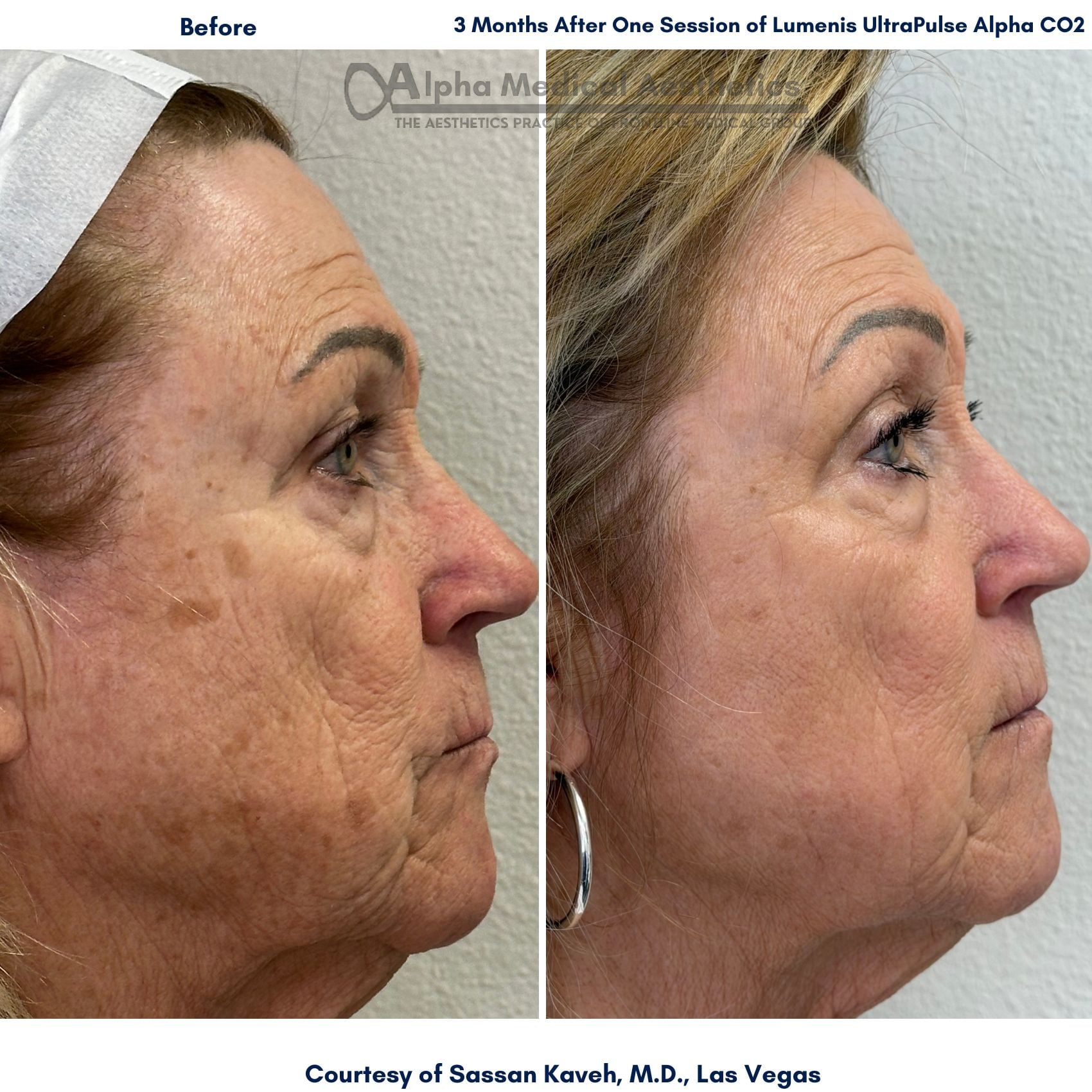 Alpha Medical Aesthetics Lumenis UltraPulse Alpha CO2 Laser Before and After Pictures by Dr Sassan Kaveh in Summerlin of Las Vegas