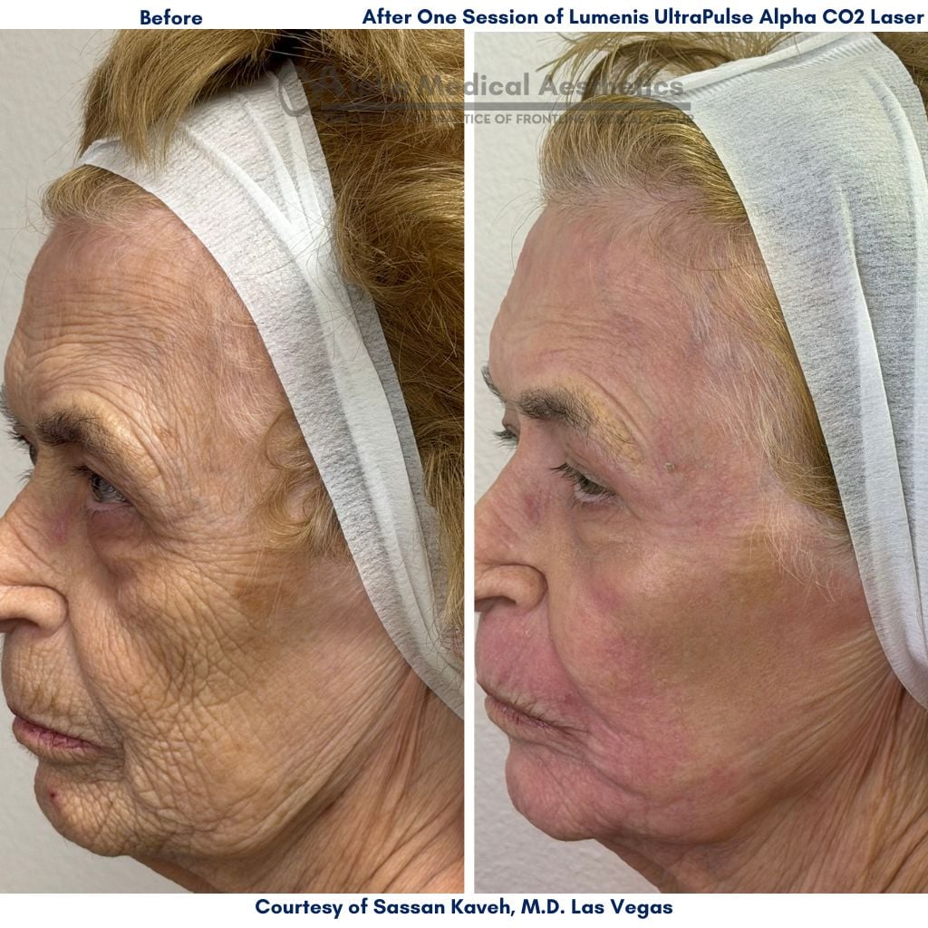 Vascular Lesions Treatment by Nd Yag