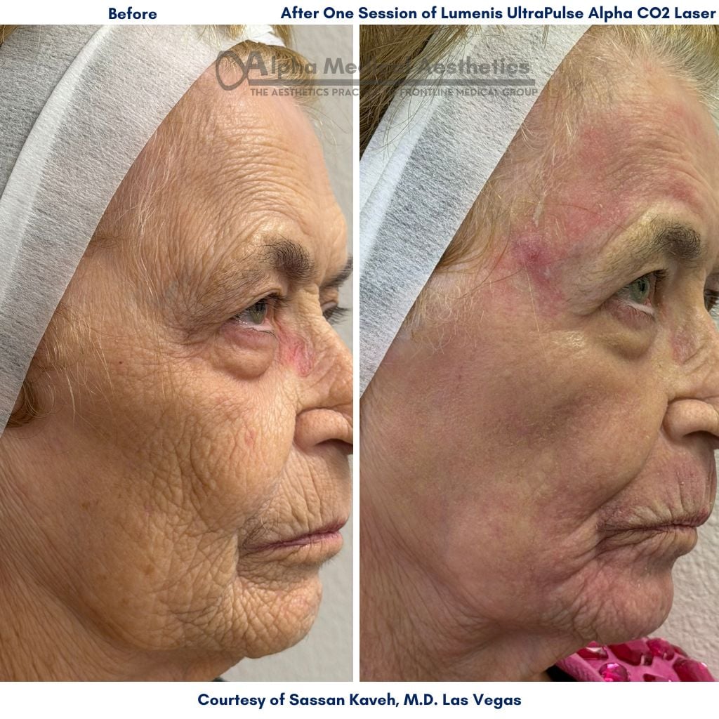 Alpha Medical Aesthetics Lumenis UltraPulse Alpha CO2 Laser Before and After Pictures by Dr Sassan Kaveh in Summerlin of Las Vegas