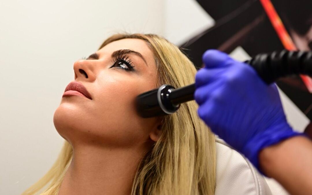 RF Microneedling in Las Vegas: Better Than Fillers for Fine Lines?