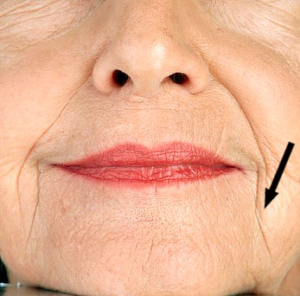 Alpha_Medical_Aesthetics_Lumenis_triLift_Marionette_Reduction_Summerlin