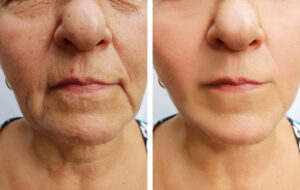 Alpha_Medical_Aesthetics_Lumenis_SmoothGLO_Marionette_Reduction_Drawbacks_of_Surgical_Facelifts_Summerlin