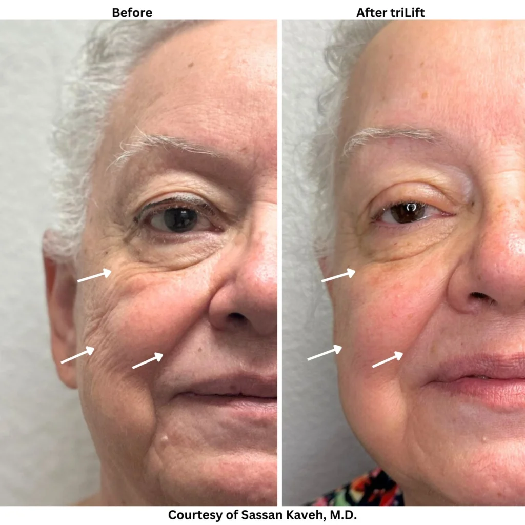 Alpha_Medical_Aesthetics_Lumenis_triLift_Non_Surgical_Face_Lift_Las_Vegas_Summerlin Alpha_Medical_Aesthetics_Lumenis_triLift_Non_Surgical_Face_Lift_Las_Vegas_Summerlin
