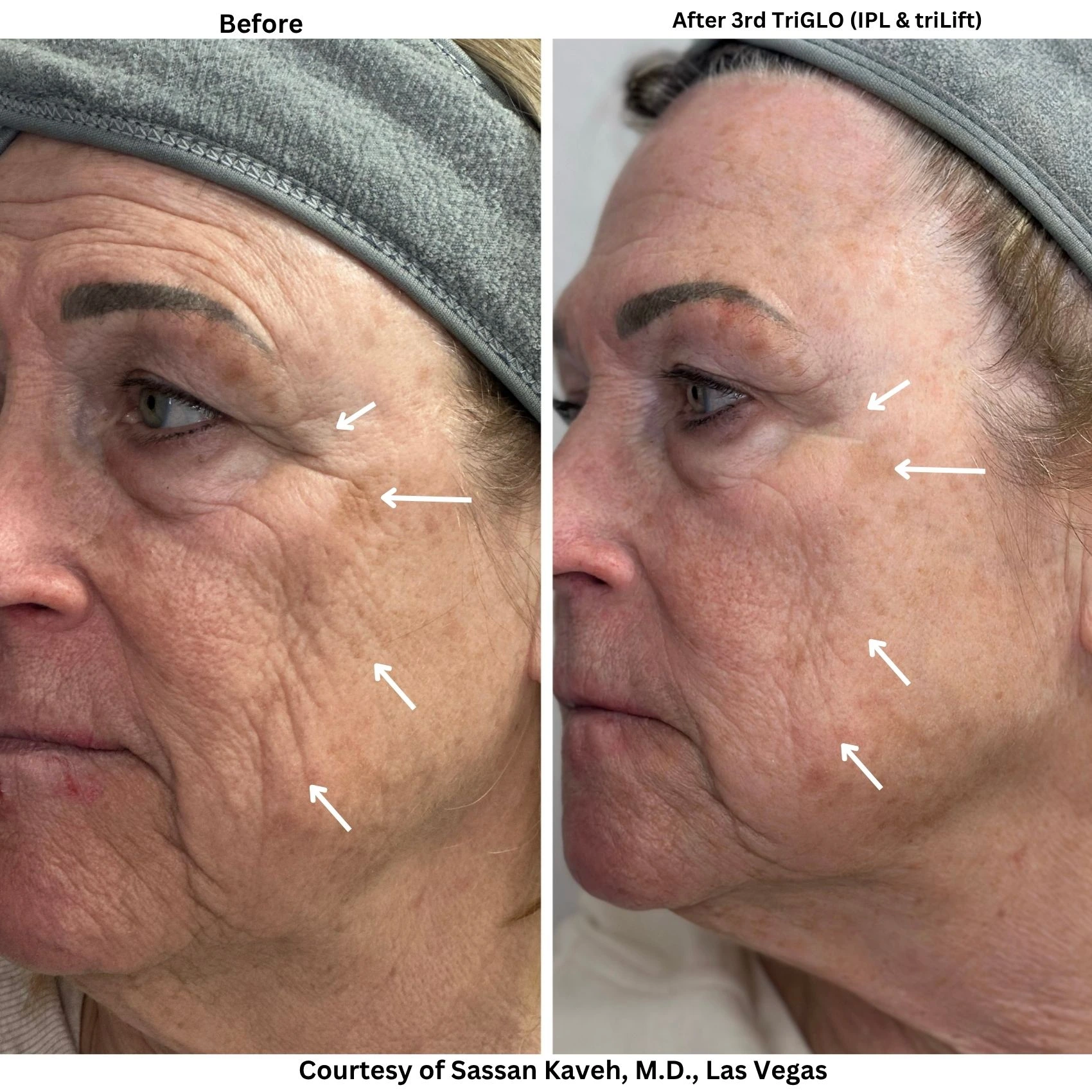 Vascular Lesions Treatment by Nd Yag