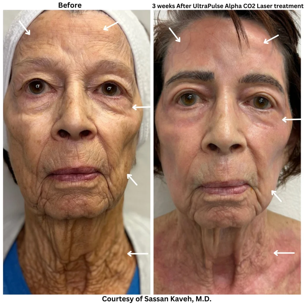 Alpha_Medical_Aesthetics_Lumenis_UltraPulse_Alpha_CO2_Laser_Resurfacing_Las_Vegas_Before_And_After Alpha_Medical_Aesthetics_Lumenis_UltraPulse_Alpha_CO2_Laser_Resurfacing_Las_Vegas_Before_And_After