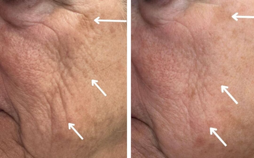 Non-Surgical Facelift Costs & Options explained by Dr. Kaveh