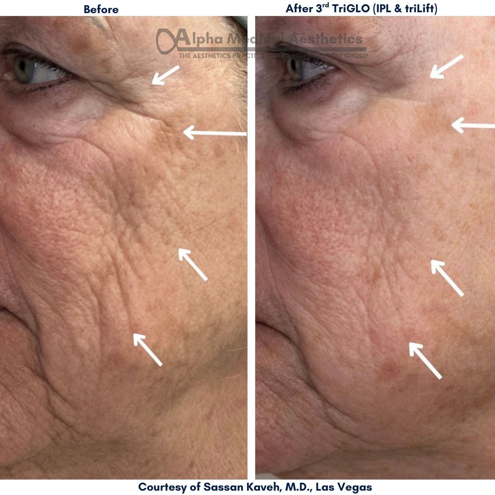 Alpha_Medical_Aesthetics_TriGLO_Combination_Of_IPL_And_triLift_Dr._Sassan_Kaveh_Las_Vegas