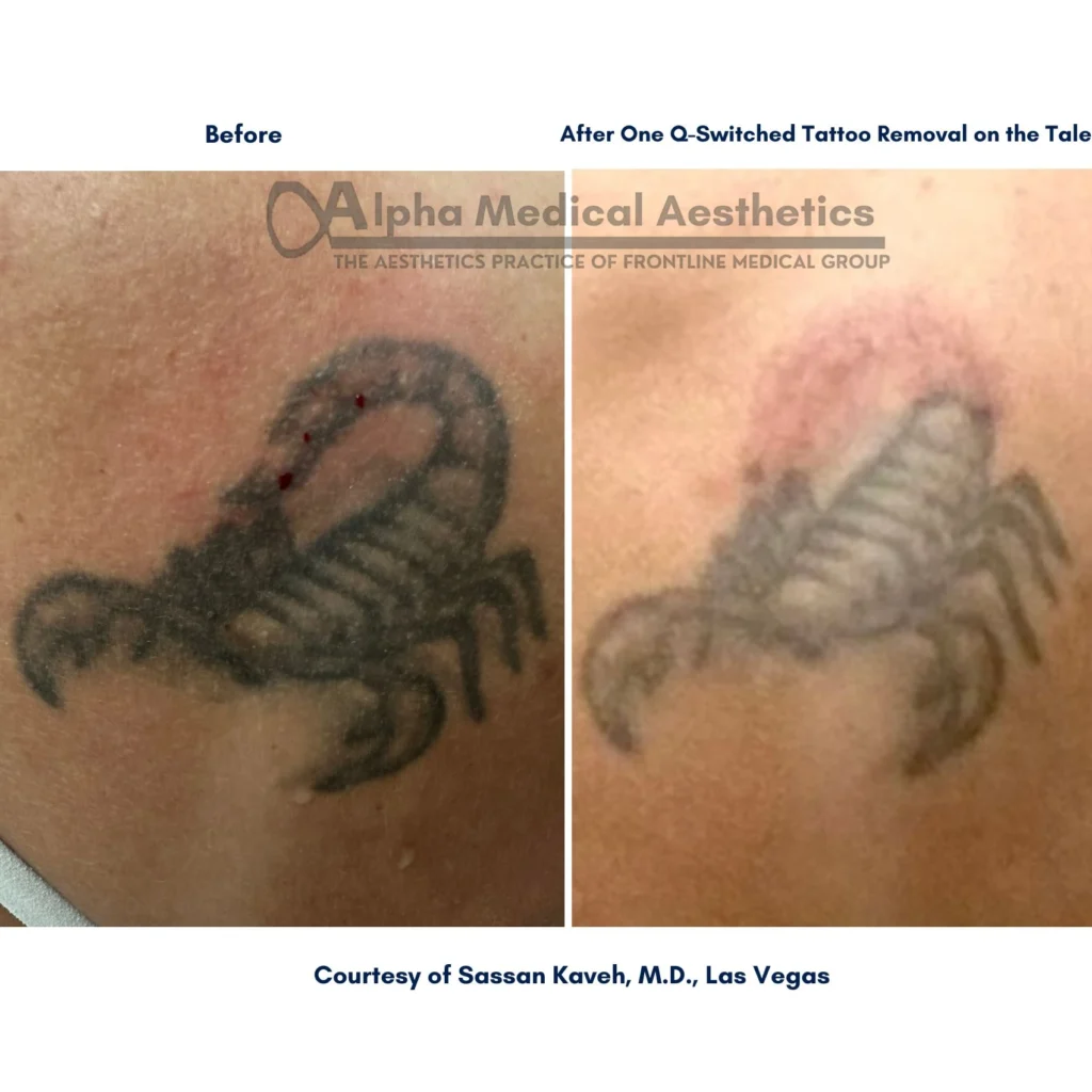 Alpha_Medical_Aesthetics_Lumenis_Q-Switched_Laser_Tattoo_Removal_Before_And_After_Dr._Sassan_Kaveh Alpha_Medical_Aesthetics_Lumenis_Q-Switched_Laser_Tattoo_Removal_Before_And_After_Dr._Sassan_Kaveh_Las_Vegas
