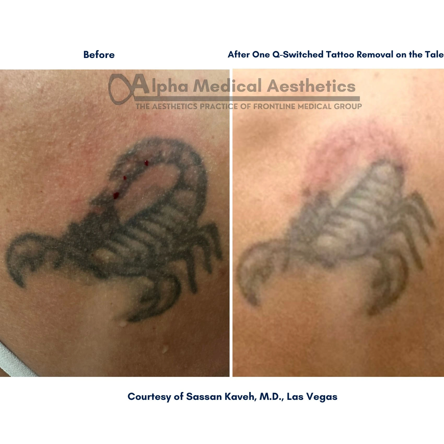 Alpha_Medical_Aesthetics_Lumenis_Q-Switched_Laser_Tattoo_Removal_Before_And_After_Dr._Sassan_Kaveh_Las_Vegas