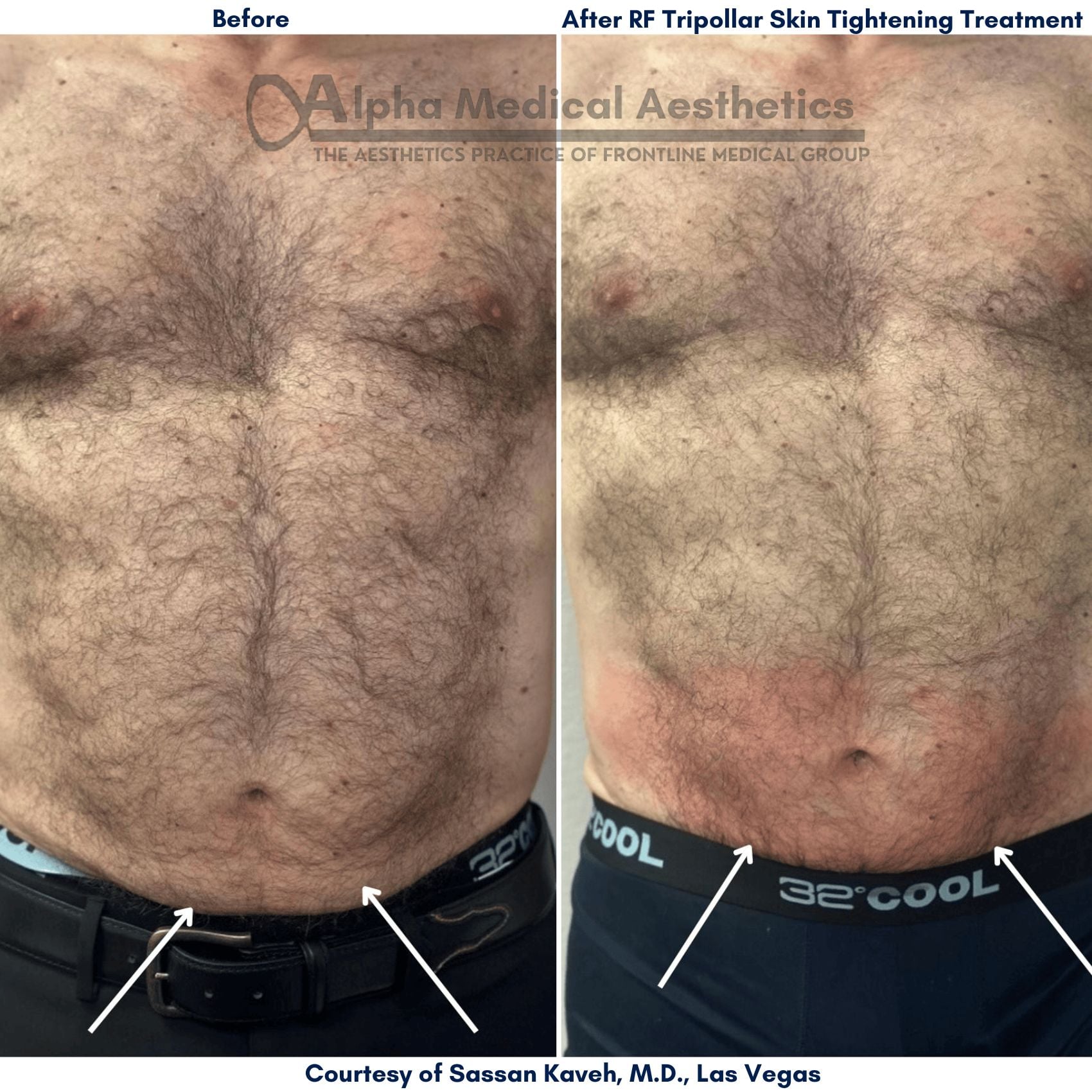 Soft Tissue Treatment by NuEra® tight - Alpha Medical Aesthetics
