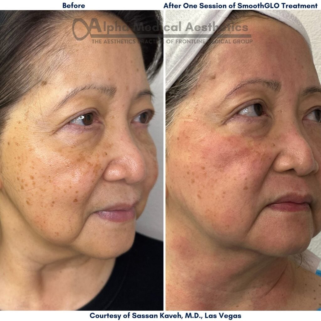Alpha_Medical_Aesthetics_Lumenis_SmoothGLO_Treatment_Before_And_After_Las_Vegas_Dr._Sassan_Kaveh_Desert_Shores Alpha_Medical_Aesthetics_Lumenis_SmoothGLO_Treatment_Before_And_After_Las_Vegas_Dr._Sassan_Kaveh_Desert_Shores