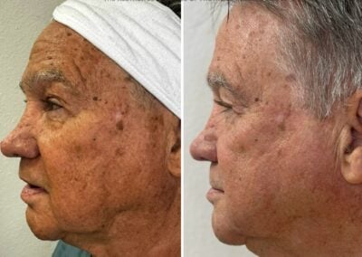 Alpha_Medical_Aesthetics_Lumenis_SmoothGLO_IPL_And_RF_Microneedling_Combination_Treatment_Las_Vegas_Dr._Sassan_Kaveh_Summerlin