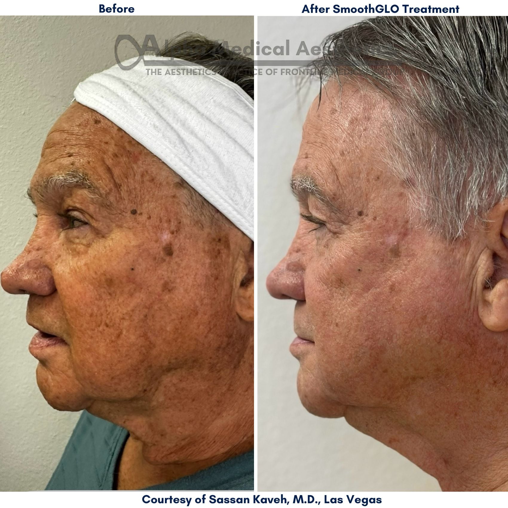 Vascular Lesions Treatment by Nd Yag
