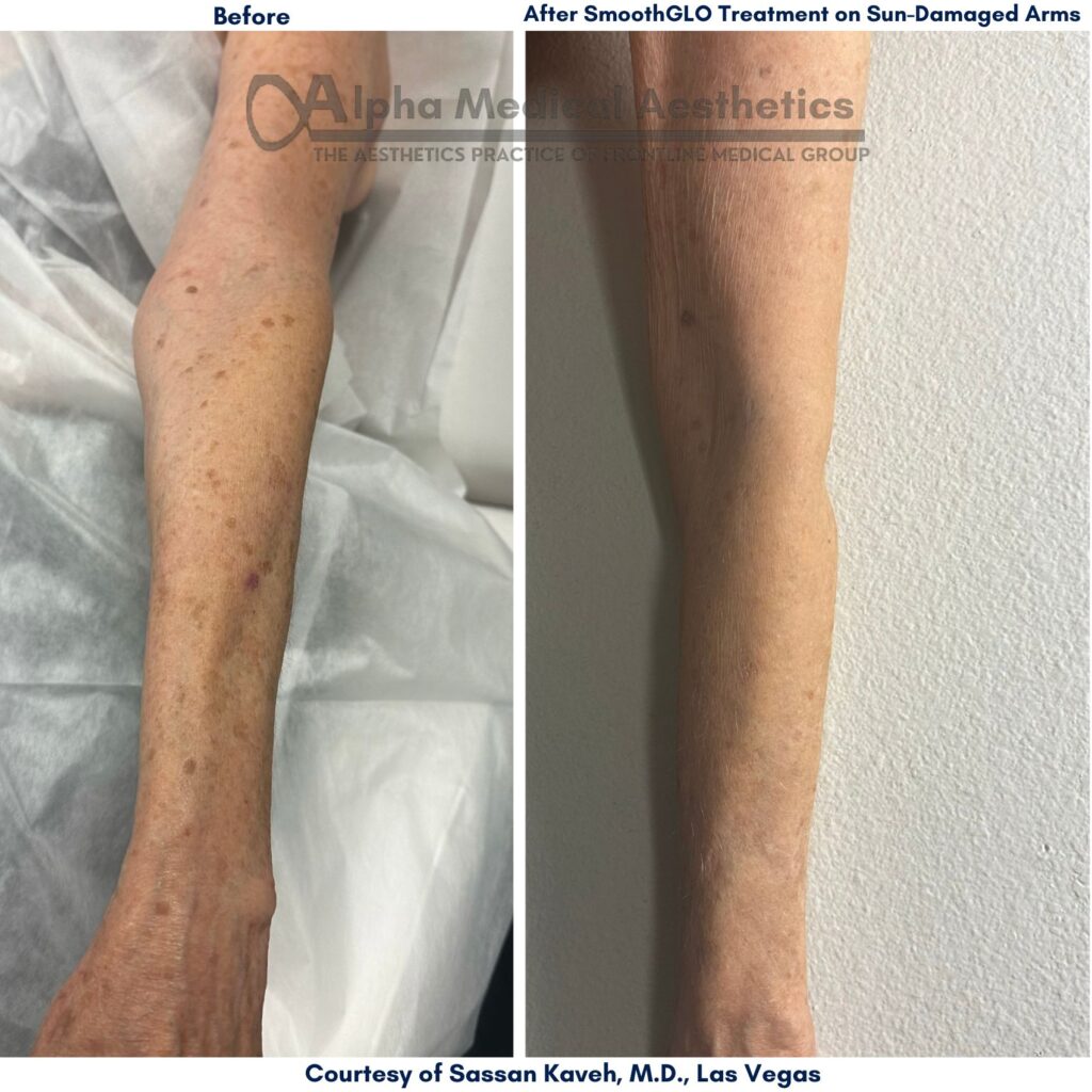Alpha_Medical_Aesthetics_Lumenis_SmoothGLO_Treatment_Sun-damaged_Arms_Las_Vegas_Dr._Sassan_Kaveh_Henderson Alpha_Medical_Aesthetics_Lumenis_SmoothGLO_Treatment_Sun-damaged_Arms_Las_Vegas_Dr._Sassan_Kaveh_Henderson