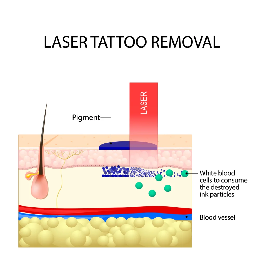 Alpha_Medical_Aesthetics_Lumenis_Tattoo_Removal_Safe_For_Your_Skin_Summerlin Alpha_Medical_Aesthetics_Lumenis_Tattoo_Removal_Safe_For_Your_Skin_Summerlin
