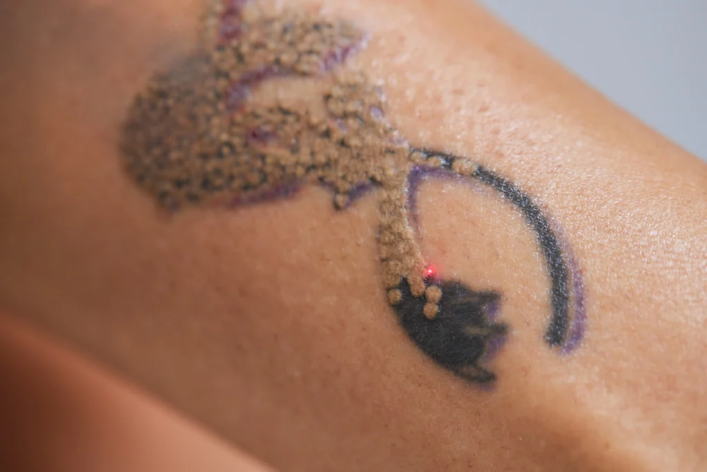 Alpha_Medical_Aesthetics_Lumenis_Q-Switched_Laser_Tattoo_Removal_Dr._Sassan_Kaveh Alpha_Medical_Aesthetics_Lumenis_Q-Switched_Laser_Tattoo_Removal_Dr._Sassan_Kaveh