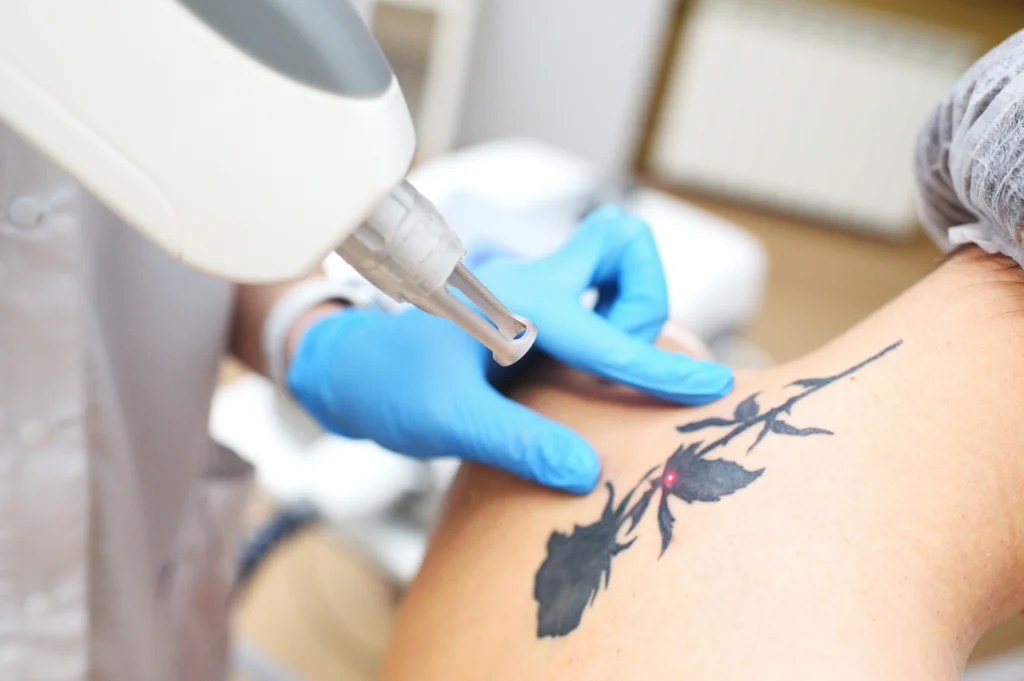 Alpha_Medical_Aesthetics_Lumenis_Tattoo_Removal_Dr._Sassan_Kaveh_Las_Vegas_Summerlin Alpha_Medical_Aesthetics_Lumenis_Tattoo_Removal_Dr._Sassan_Kaveh_Las_Vegas_Summerlin
