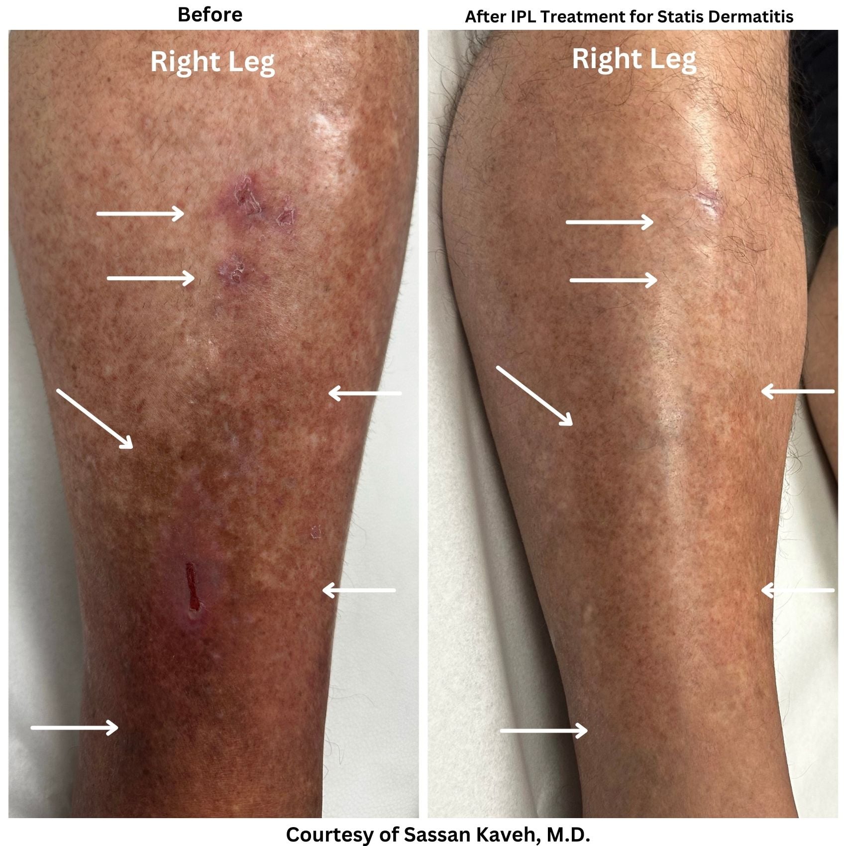 Alpha_Medical_Aesthetics_Lumenis_IPL_Treatment_For_Stasis_Dermatitis_Before_And_After_By_Dr._Sassan_Kaveh_Las_Vegas