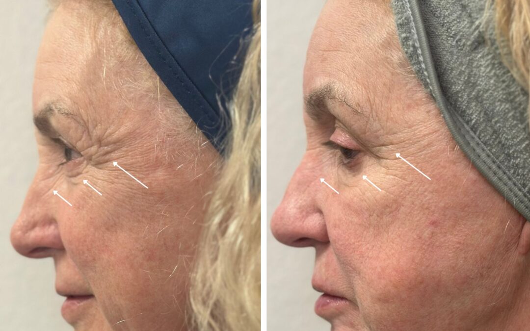 What is ResurFX Laser and How Does It Work?