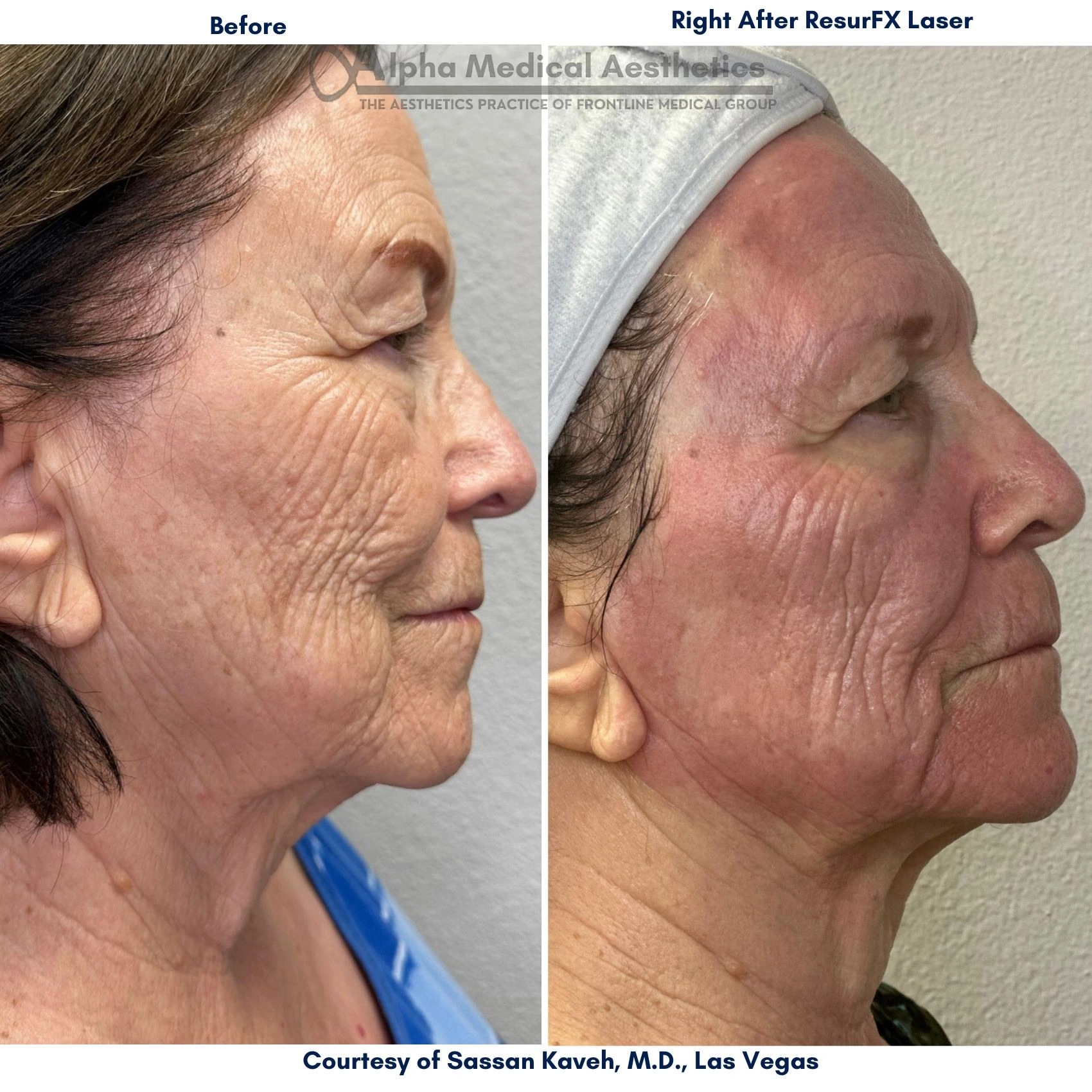 Alpha Medical Aesthetics Lumenis ResurFX For Male Dr Sassan Kaveh Las Vegas Desert Shores