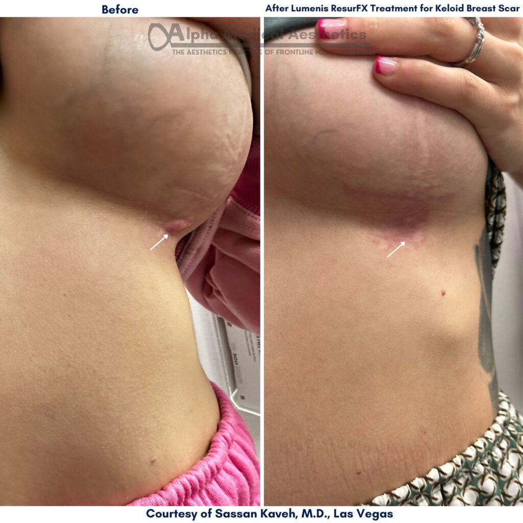 Alpha_Medical_Aesthetics_Lumenis_Stellar_M22_ResurFX_Before_And_After_Keloid_Breast_Scar_Treatment_Dr._Sassan_Kaveh_Las_Vegas_Desert_Shores Alpha_Medical_Aesthetics_Lumenis_Stellar_M22_ResurFX_Before_And_After_Keloid_Breast_Scar_Treatment_Dr._Sassan_Kaveh_Las_Vegas_Desert_Shores