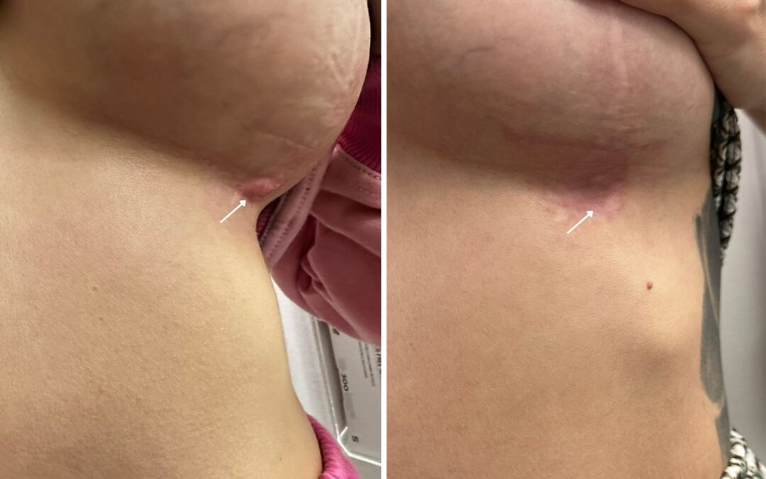 How Much Does ResurFX Laser Cost?
