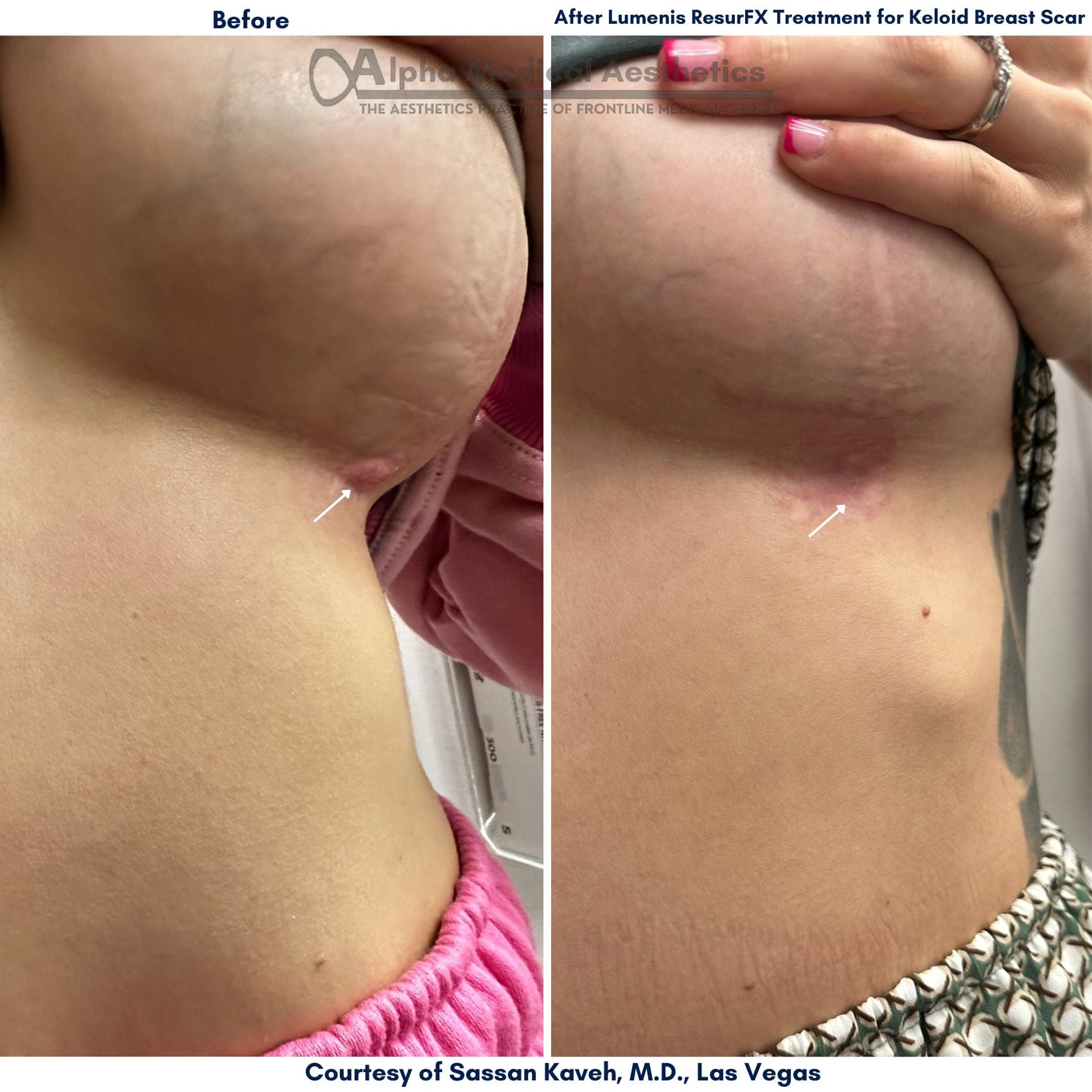Alpha_Medical_Aesthetics_Lumenis_Stellar_M22_ResurFX_Before_And_After_Keloid_Breast_Scar_Treatment_Dr._Sassan_Kaveh_Las_Vegas_Desert_Shores