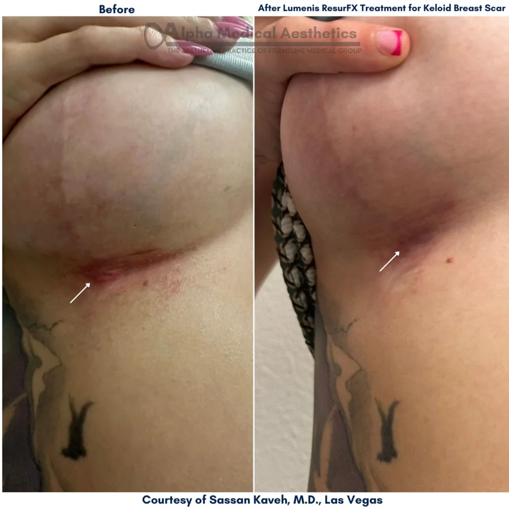 Alpha_Medical_Aesthetics_Lumenis_Stellar_M22_ResurFX_Before_And_After_Keloid_Breast_Scar_Treatment_Dr._Sassan_Kaveh_Las_Vegas_Summerlin Alpha_Medical_Aesthetics_Lumenis_Stellar_M22_ResurFX_Before_And_After_Keloid_Breast_Scar_Treatment_Dr._Sassan_Kaveh_Las_Vegas_Summerlin