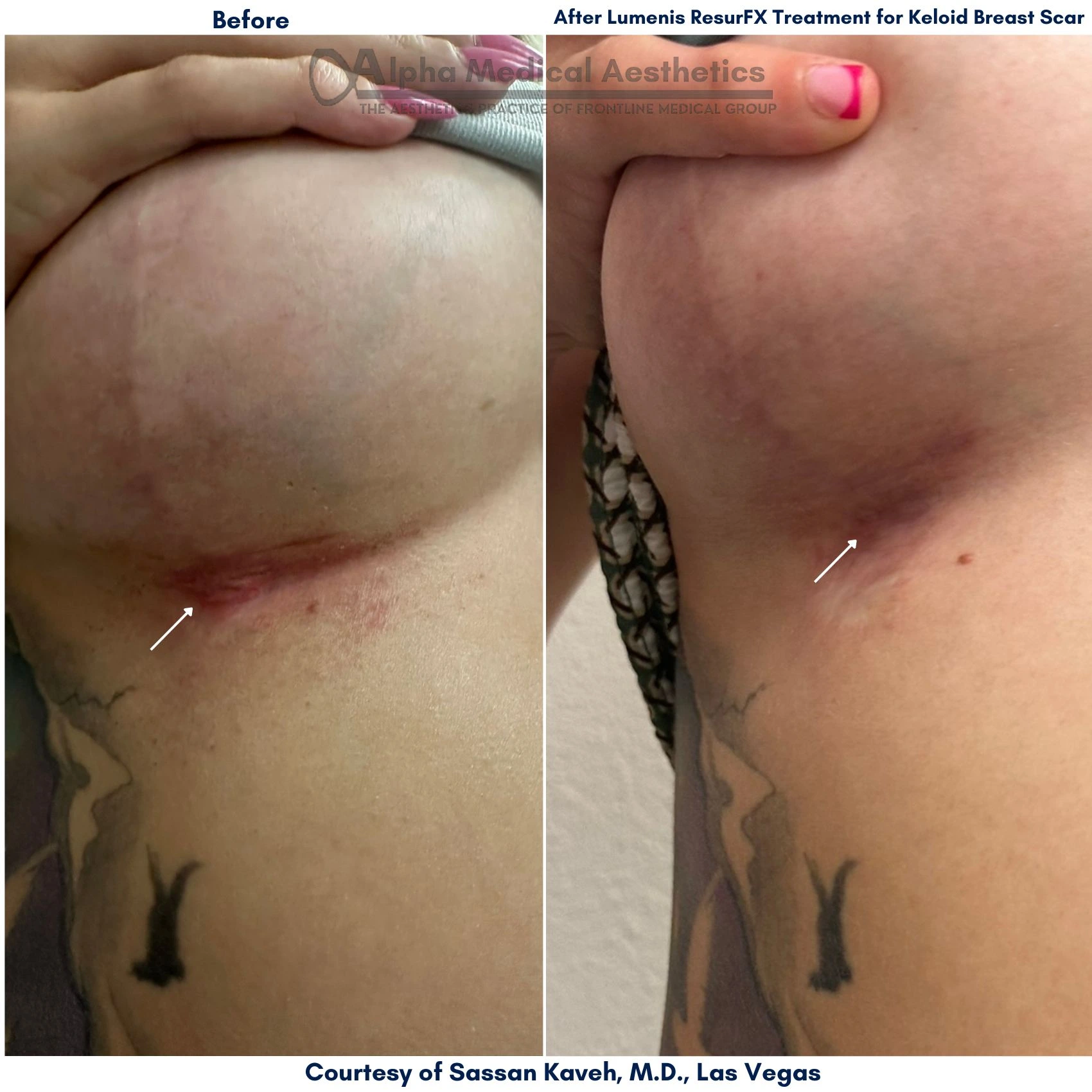 Alpha_Medical_Aesthetics_Lumenis_Stellar_M22_ResurFX_Before_And_After_Keloid_Breast_Scar_Treatment_Dr._Sassan_Kaveh_Las_Vegas_Summerlin