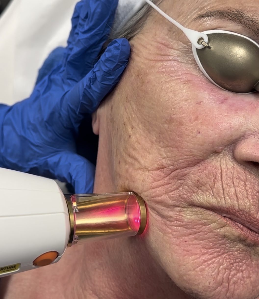 Alpha_Medical_Aesthetics_Lumenis_Stellar_M22_ResurFX_Facial_Rejuvenation_Mark_Removal_Dr._Sassan_Kaveh_Las_Vegas_Strip