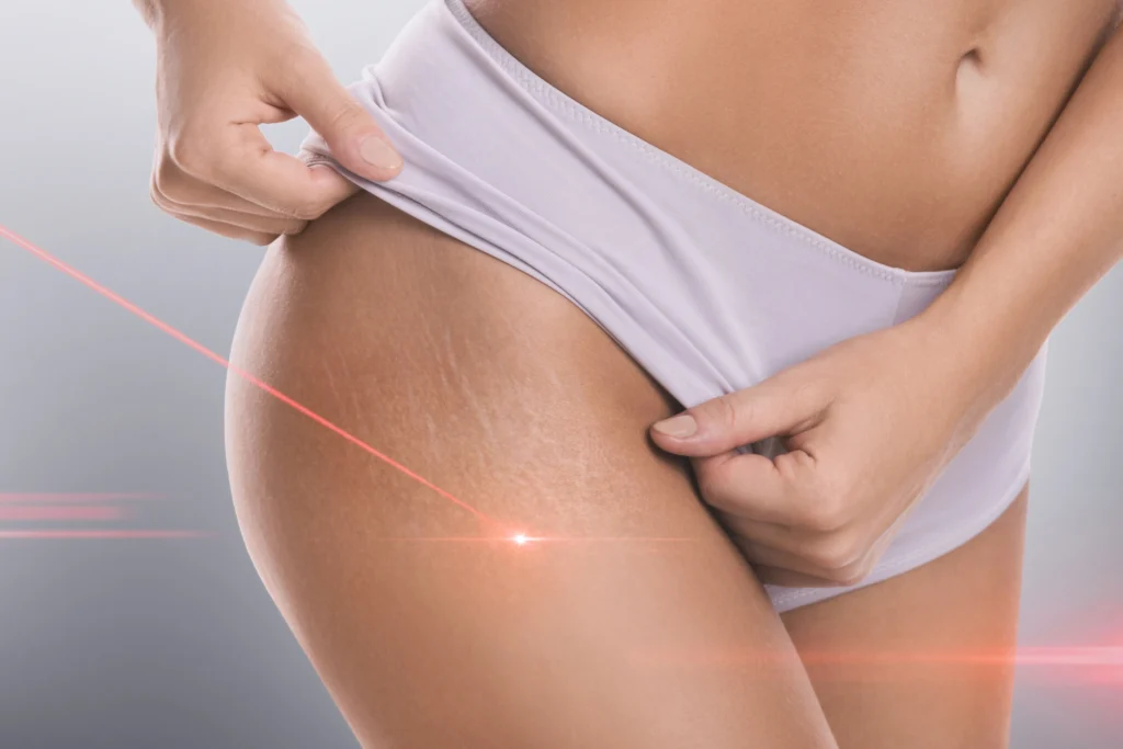 Alpha_Medical_Aesthetics_Lumenis_Stellar_M22_ResurFX_Hips_And_Thighs_Stretch_Mark_Removal_Dr._Sassan_Kaveh_Las_Vegas Alpha_Medical_Aesthetics_Lumenis_Stellar_M22_ResurFX_Hips_And_Thighs_Stretch_Mark_Removal_Dr._Sassan_Kaveh_Las_Vegas