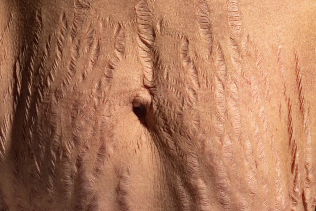 Alpha_Medical_Aesthetics_Lumenis_Stellar_M22_ResurFX_Abdomen_Stretch_Mark_Removal_Dr._Sassan_Kaveh_Las_Vegas Alpha_Medical_Aesthetics_Lumenis_Stellar_M22_ResurFX_Abdomen_Stretch_Mark_Removal_Dr._Sassan_Kaveh_Las_Vegas