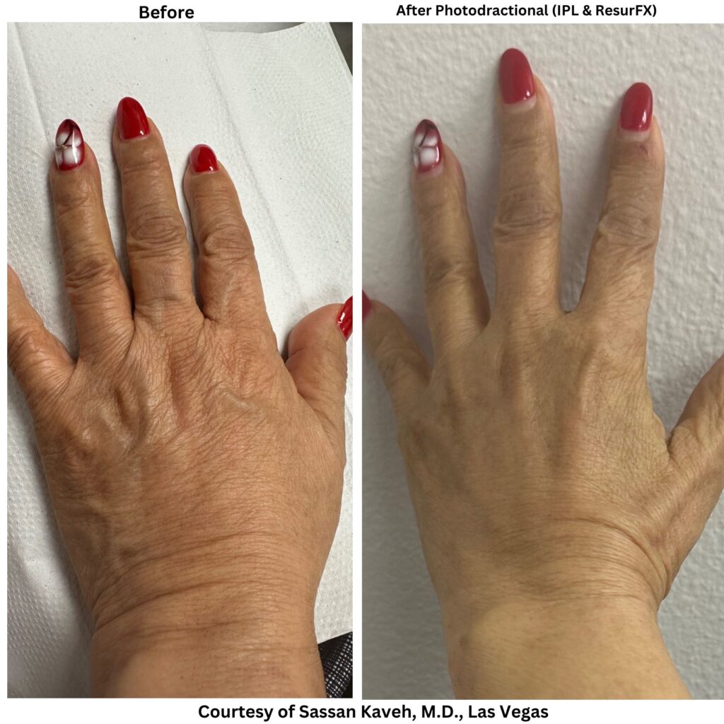Alpha_Medical_Aesthetics_Lumenis_Stellar_M22_ResurFX_and_IPL_Hand_Aging_Removal_Dr._Sassan_Kaveh_Las_Vegas Alpha_Medical_Aesthetics_Lumenis_Stellar_M22_ResurFX_and_IPL_Hand_Aging_Removal_Dr._Sassan_Kaveh_Las_Vegas