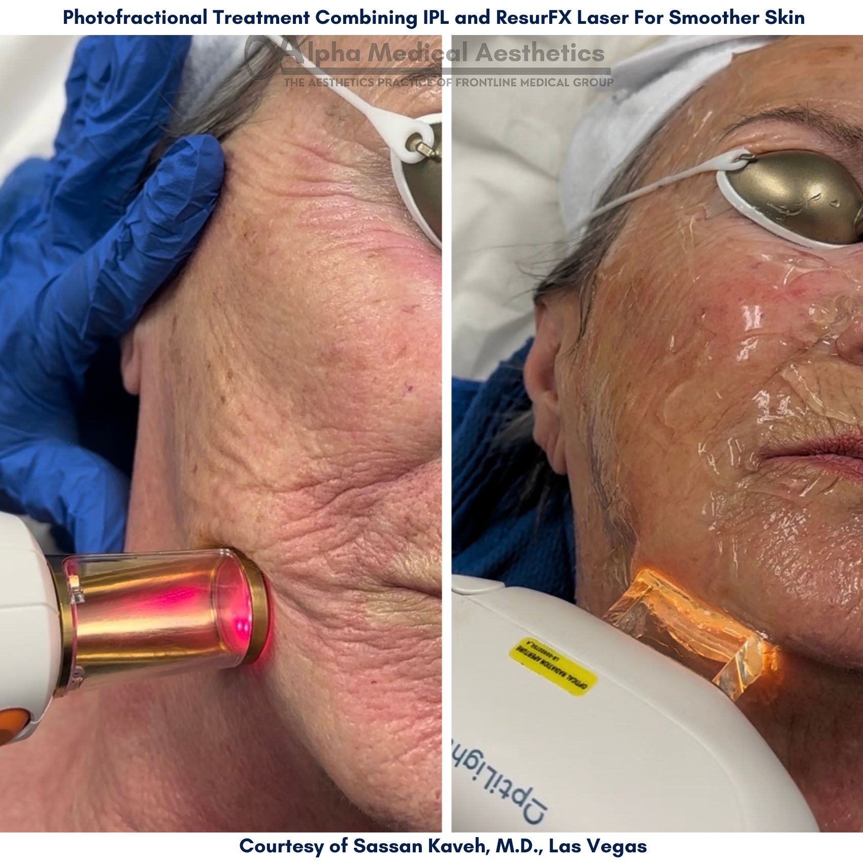 Alpha_Medical_Aesthetics_Photofractional_Treatment_Combining_IPL_and_ResurFX_Laser_At_Dr._Sassan_Kaveh's_Medical_Spa_In_Las_Vegas