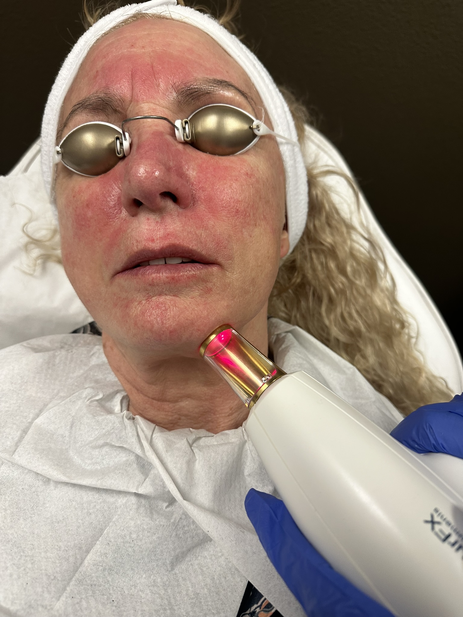 Alpha_Medical_Aesthetics_Lumenis_Stellar_M22_ResurFX_Stretch_Mark_Removal_Dr._Sassan_Kaveh_Las_Vegas_Strip Alpha_Medical_Aesthetics_Lumenis_Stellar_M22_ResurFX_Stretch_Mark_Removal_Dr._Sassan_Kaveh_Las_Vegas_Strip