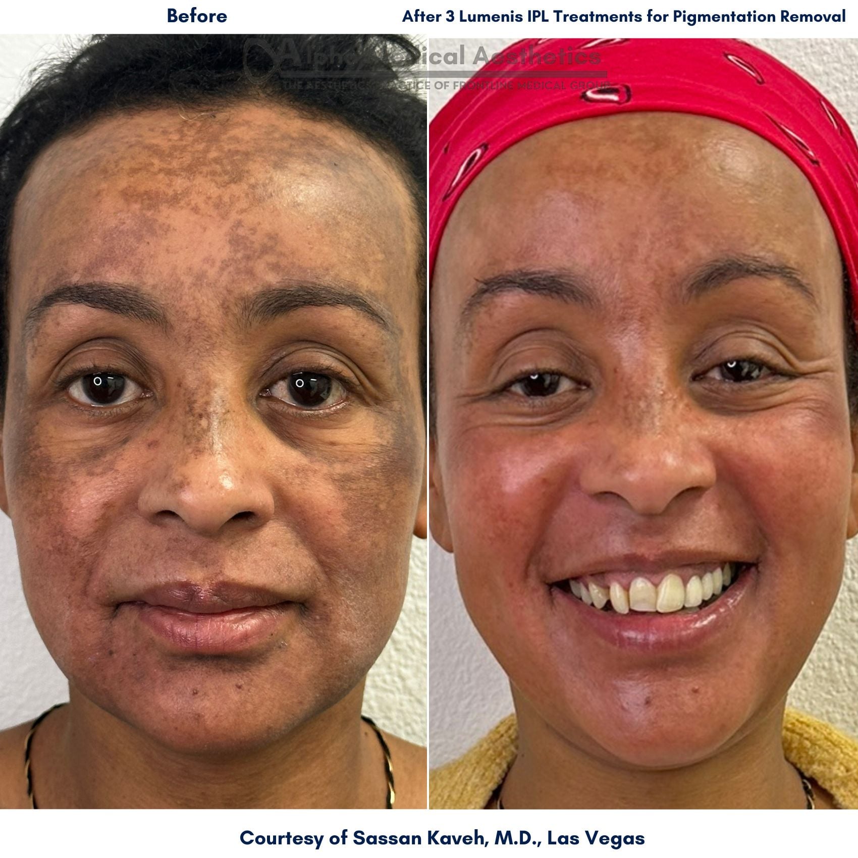 Alpha_Medical_Aesthetics_IPL_Treatment_Before_And_After_Dr._Sassan_Kaveh_Las_Vegas_Summerlin
