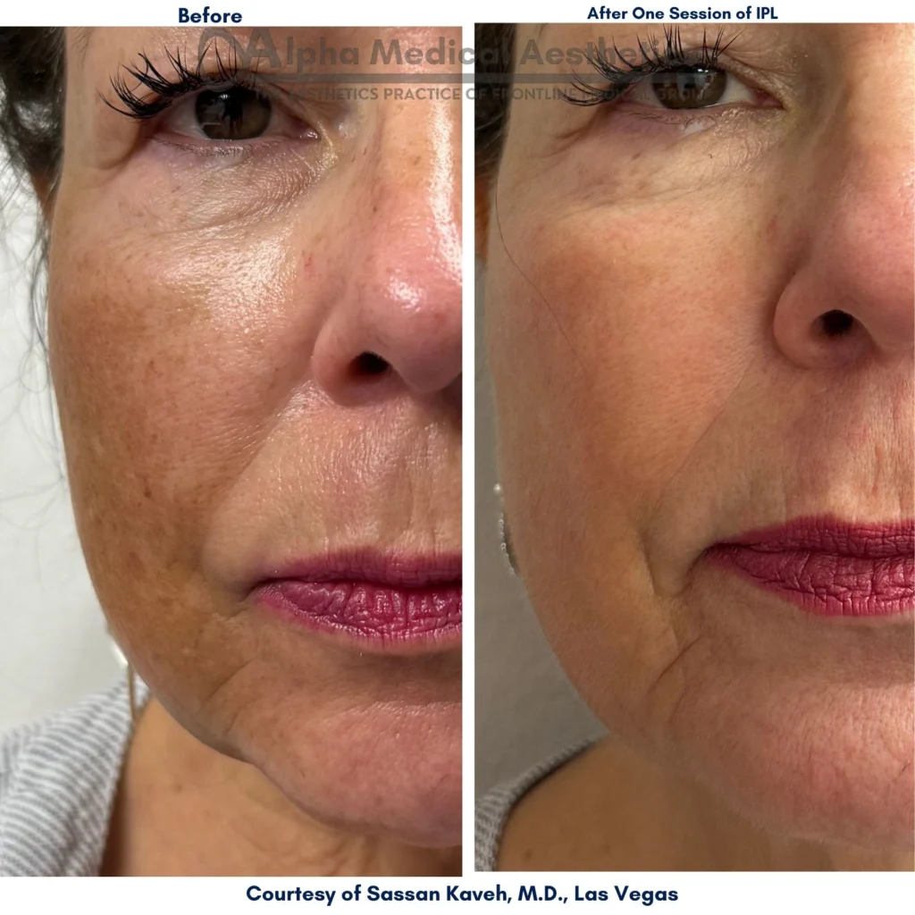 Alpha_Medical_Aesthetics_IPL_Treatment_Before_And_After_Dr._Sassan_Kaveh_Las_Vegas_Desert_Shores Alpha_Medical_Aesthetics_IPL_Treatment_Before_And_After_Dr._Sassan_Kaveh_Las_Vegas_Desert_Shores