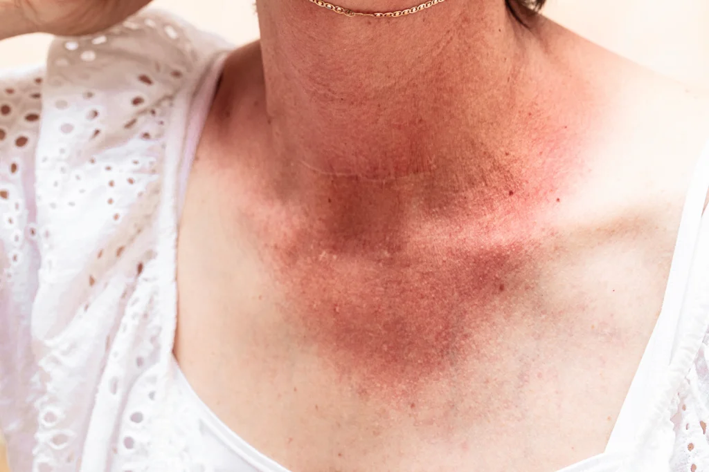 Alpha_Medical_Aesthetics_Doesn't_Recommend_IPL_Treatment_With_Tanned_Skin